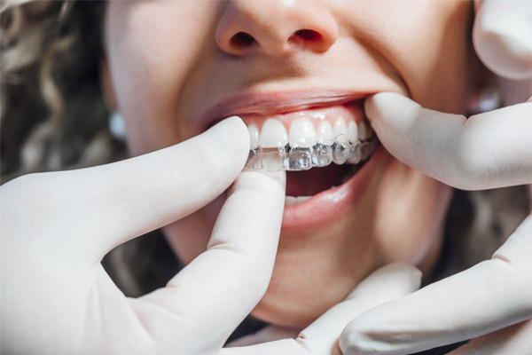 Get Invisalign in Warsaw IN from the best Invisalign provider