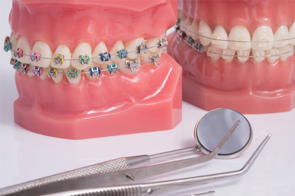 Ceramic Braces: Ancient Origins, Bright Future! - Sunbury Dental House