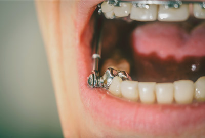 Learn more about orthodontic appliances