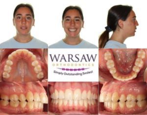 Invisalign vs. Smile Direct Club - Warsaw Orthodontics