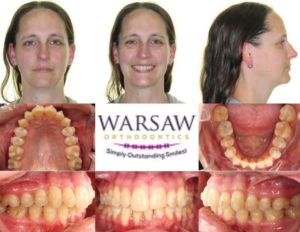 Invisalign vs. Smile Direct Club - Warsaw Orthodontics