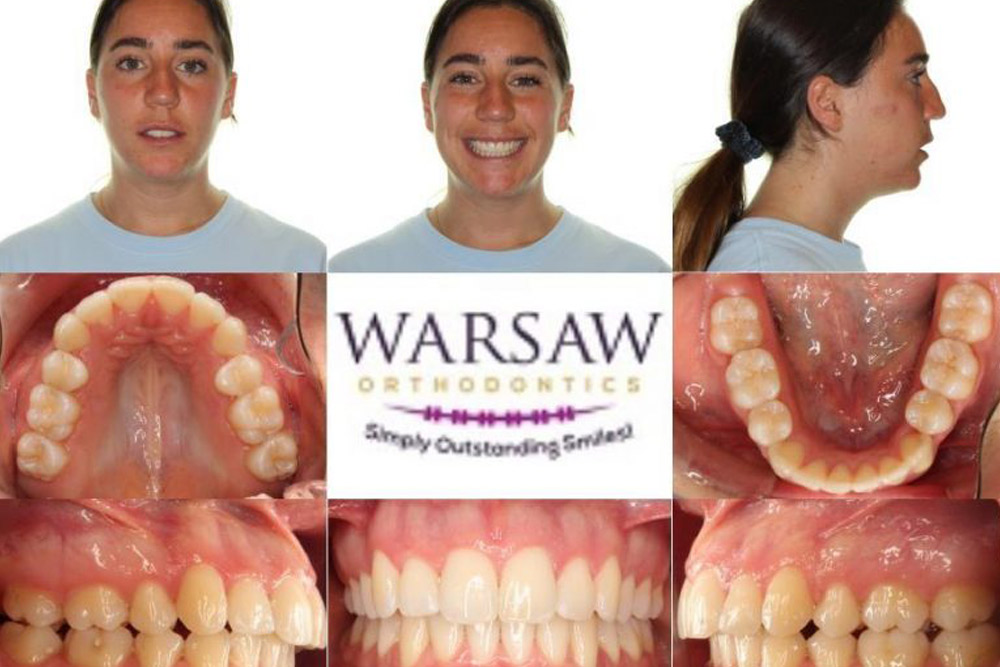 Invisalign vs. Smile Direct Club Warsaw Orthodontics